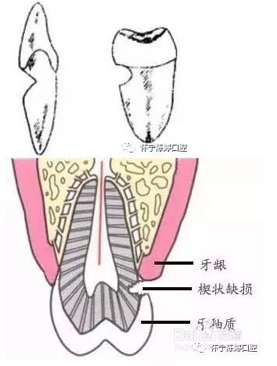 什么是牙齒楔缺？