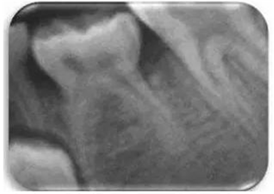 文獻(xiàn)直達(dá)｜一項(xiàng)西班牙的研究：低位乳磨牙的發(fā)生頻率、程度、牙根吸收和前磨牙發(fā)育不全情況