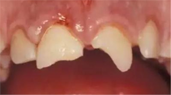 臨床實踐｜乳牙外傷處理指引（值得兒牙醫生收藏）