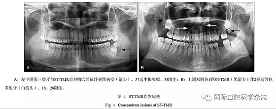 46例患者第三磨牙區多生牙的影像學分析