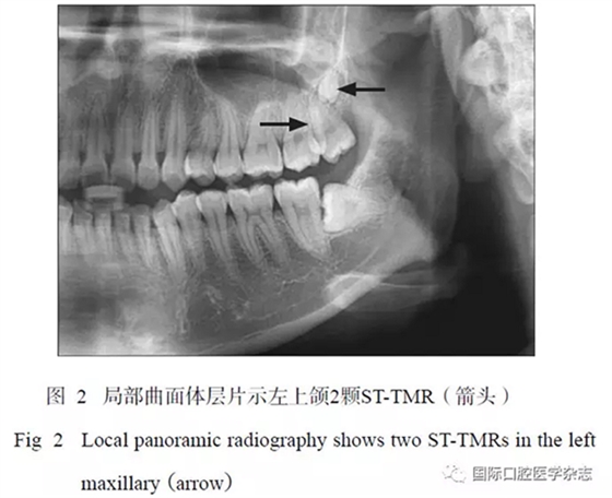 46例患者第三磨牙區多生牙的影像學分析