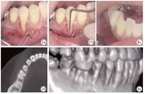 側向轉位瓣結合上皮下結締組織移植治療重度MillerⅢ°牙齦退縮1例