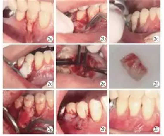 側向轉位瓣結合上皮下結締組織移植治療重度MillerⅢ°牙齦退縮1例