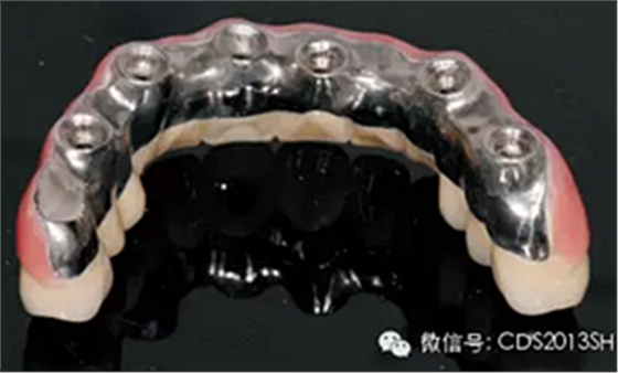 【經驗分享】無牙頜種植修復固位的并發癥與處理——宋應亮教授