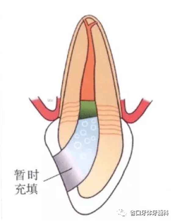 上前牙根管再治療后內漂白1例