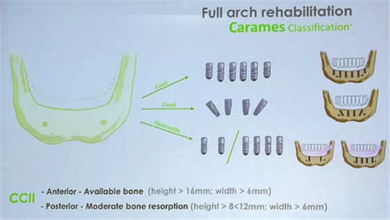 【熱點回顧】帶您深度了解無牙頜種植修復——Pro Arch