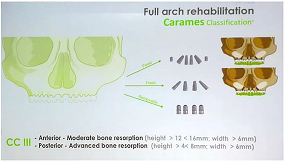 【熱點回顧】帶您深度了解無牙頜種植修復——Pro Arch