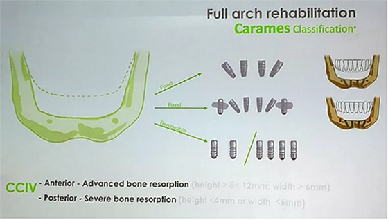 【熱點回顧】帶您深度了解無牙頜種植修復——Pro Arch