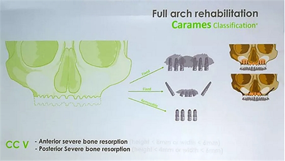 【熱點回顧】帶您深度了解無牙頜種植修復——Pro Arch