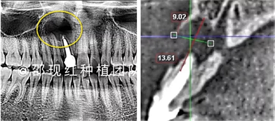 「科普篇」你真的了解它嗎？——β-磷酸三鈣