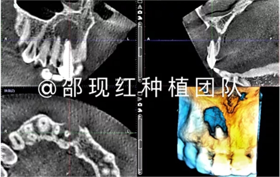 「科普篇」你真的了解它嗎？——β-磷酸三鈣