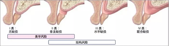 【文獻精讀】唇-齒-牙槽嵴分類：無牙頜上頜牙弓指南。診斷，風險評估及種植治療指征