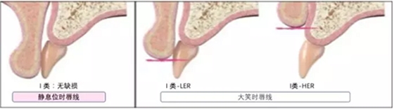 【文獻精讀】唇-齒-牙槽嵴分類：無牙頜上頜牙弓指南。診斷，風險評估及種植治療指征