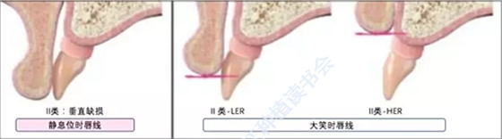 【文獻精讀】唇-齒-牙槽嵴分類：無牙頜上頜牙弓指南。診斷，風險評估及種植治療指征