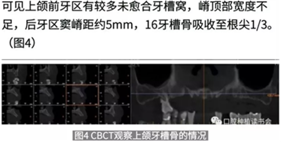 病例報道│全程數字化輔助無牙頜種植即刻負重