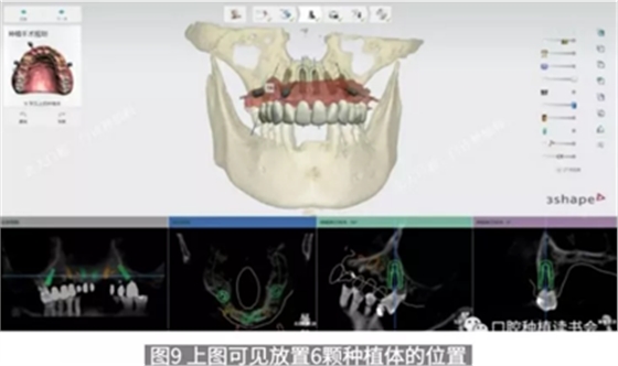 病例報道│全程數字化輔助無牙頜種植即刻負重