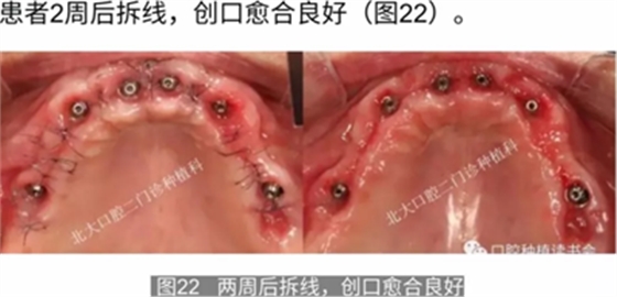 病例報道│全程數字化輔助無牙頜種植即刻負重