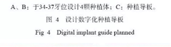 下頜骨腓骨移植聯合牙種植術后的覆蓋義齒修復1例