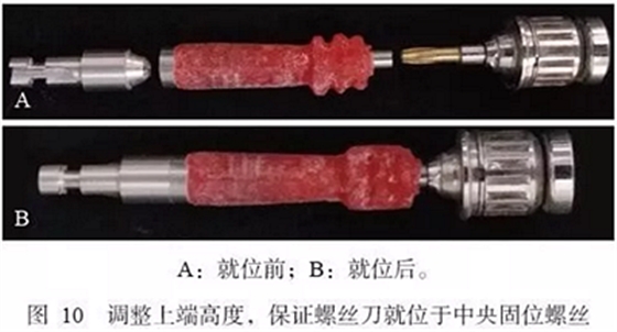 下頜骨腓骨移植聯合牙種植術后的覆蓋義齒修復1例