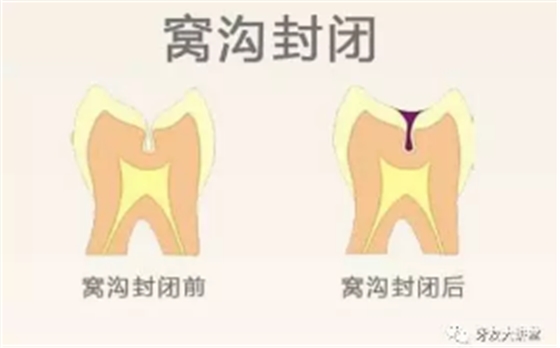 兒童防齲齒【窩溝封閉】和【涂氟】是一回事兒嗎？