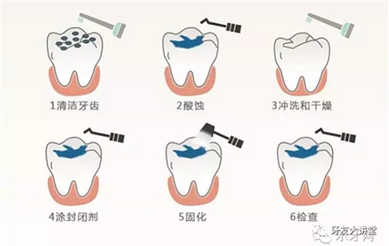 兒童防齲齒【窩溝封閉】和【涂氟】是一回事兒嗎？