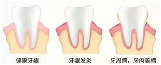 牙周炎，中國成年人后半生永遠的 痛 ！