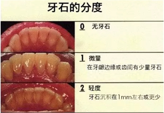 牙周炎，中國成年人后半生永遠的 痛 ！