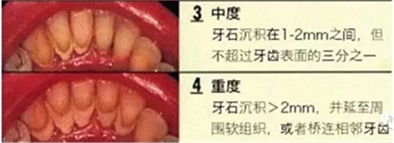 牙周炎，中國成年人后半生永遠的 痛 ！