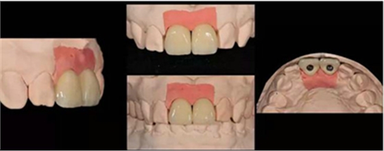 Asc全瓷角度基臺一體冠進行種植前牙美學修復一例