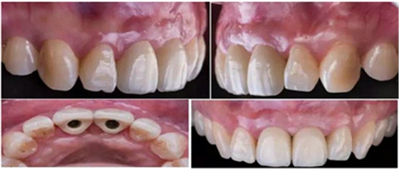 Asc全瓷角度基臺一體冠進行種植前牙美學修復一例