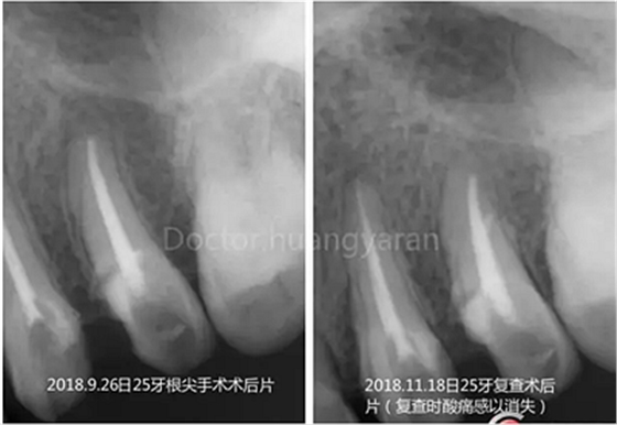 當根管治療遇見根尖骨穿孔