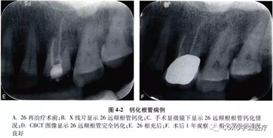 （六期）細(xì)小鈣化根管的疏通——病因及診斷