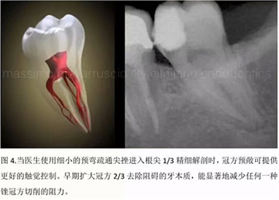 【病例分享】根管冠部預敞