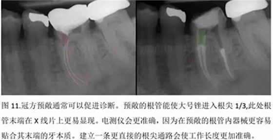 【病例分享】根管冠部預敞