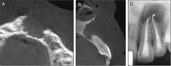 【病例分享】治療后的根尖周炎與根尖外的獨立感染