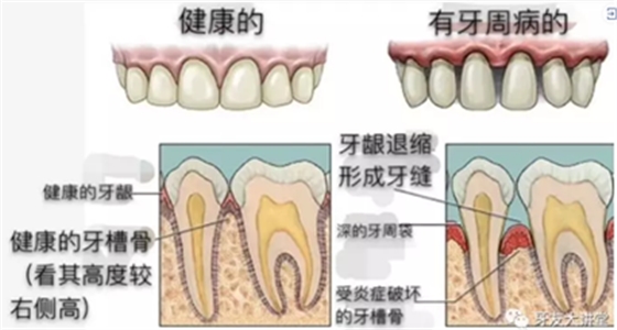 怎樣預(yù)防牙齦萎縮