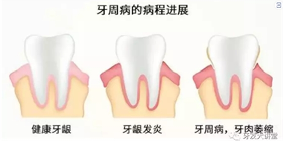 怎樣預(yù)防牙齦萎縮