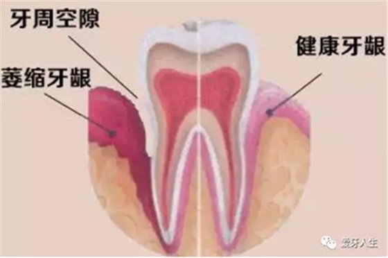 牙齦萎縮怎么辦？