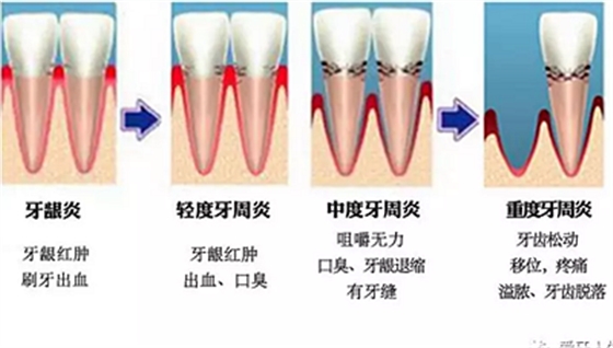 牙齦萎縮怎么辦？