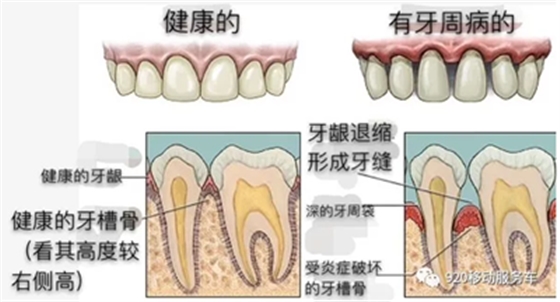 牙齦萎縮怎么辦？