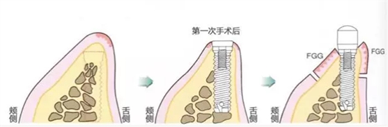 種植體周圍角化齦的獲得時期與方法