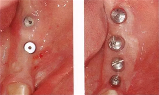 種植體周圍角化齦的獲得時期與方法