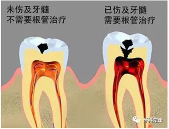 補牙不做冠，療效少一半！根管治療后牙齒已經不疼了，為什么還要戴牙冠呢？