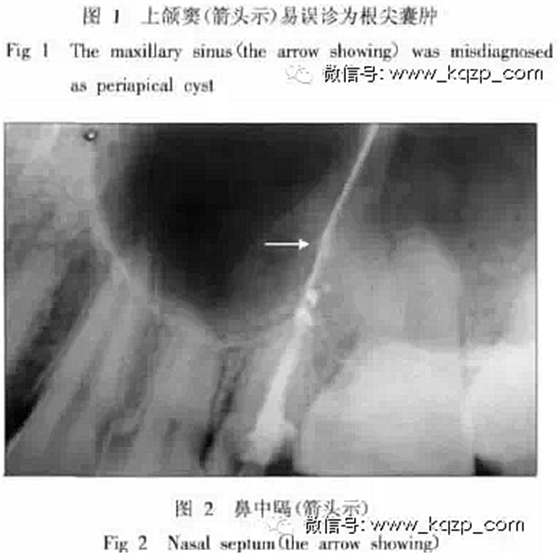 X線牙片在牙齒疑難病例診斷中的參考價值