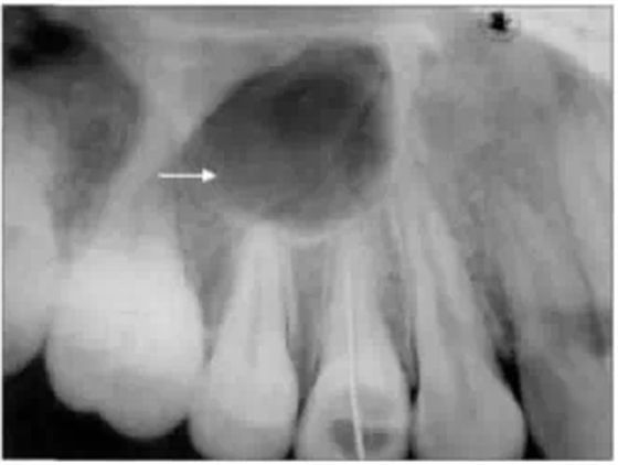 X線牙片在牙齒疑難病例診斷中的參考價值