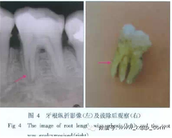 X線牙片在牙齒疑難病例診斷中的參考價值