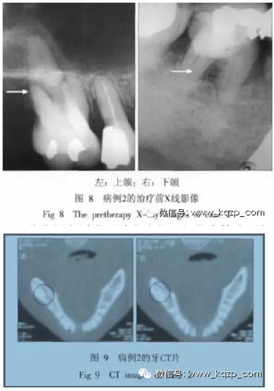 X線牙片在牙齒疑難病例診斷中的參考價值