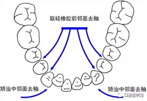 鄰面去釉技術詳解