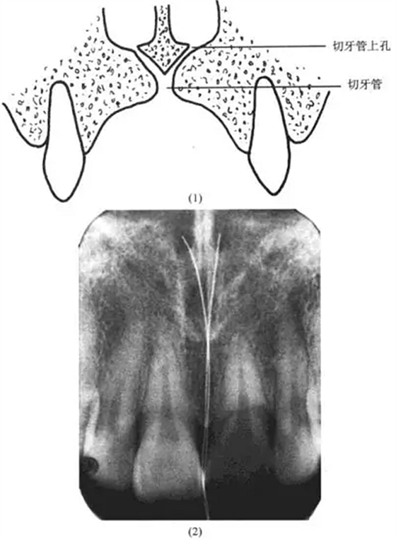切牙管上孔