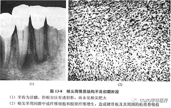 根尖周牙骨質結構不良初期階段